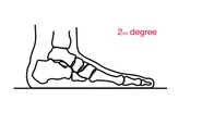 2nd degree 2nd degree